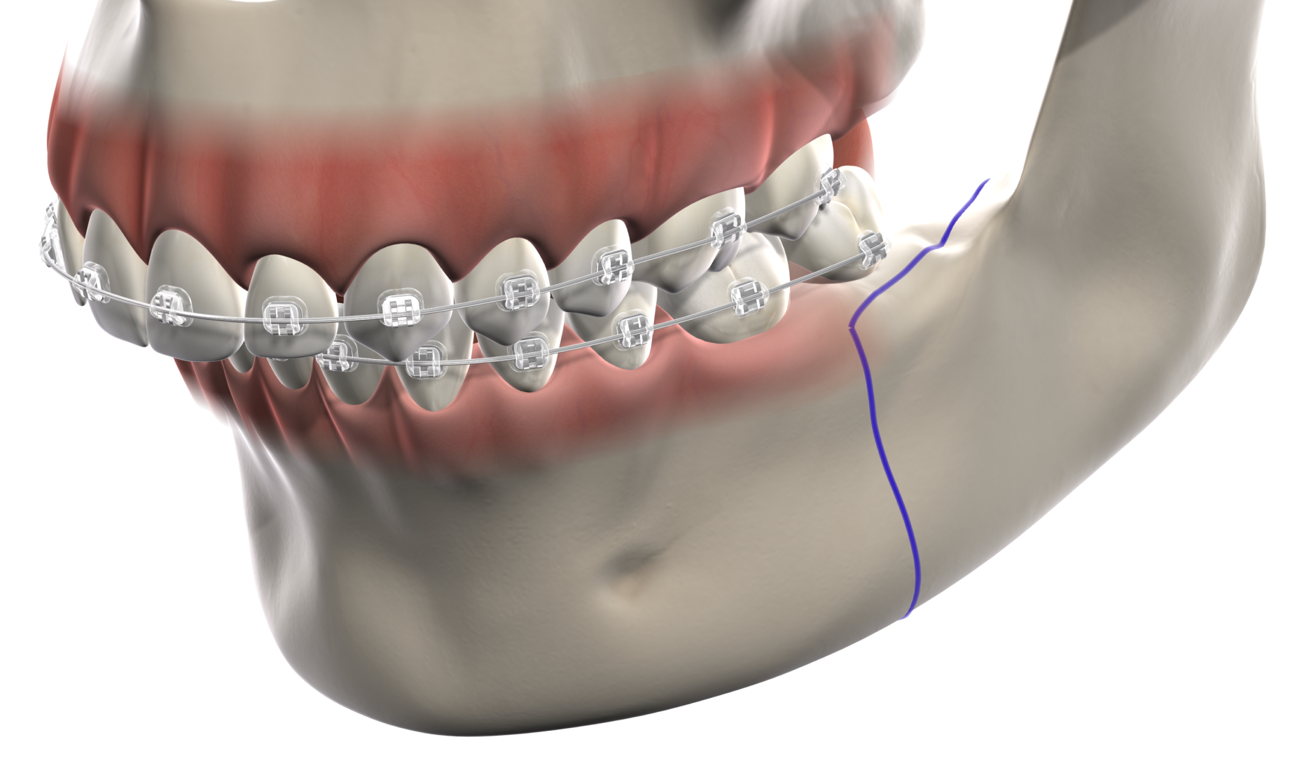 Isolated  jaw surgery