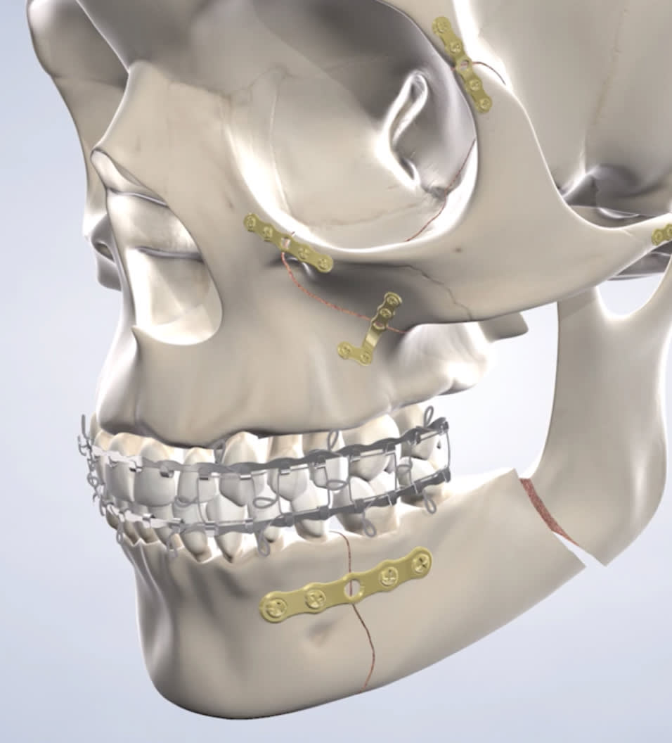 query  facial trauma