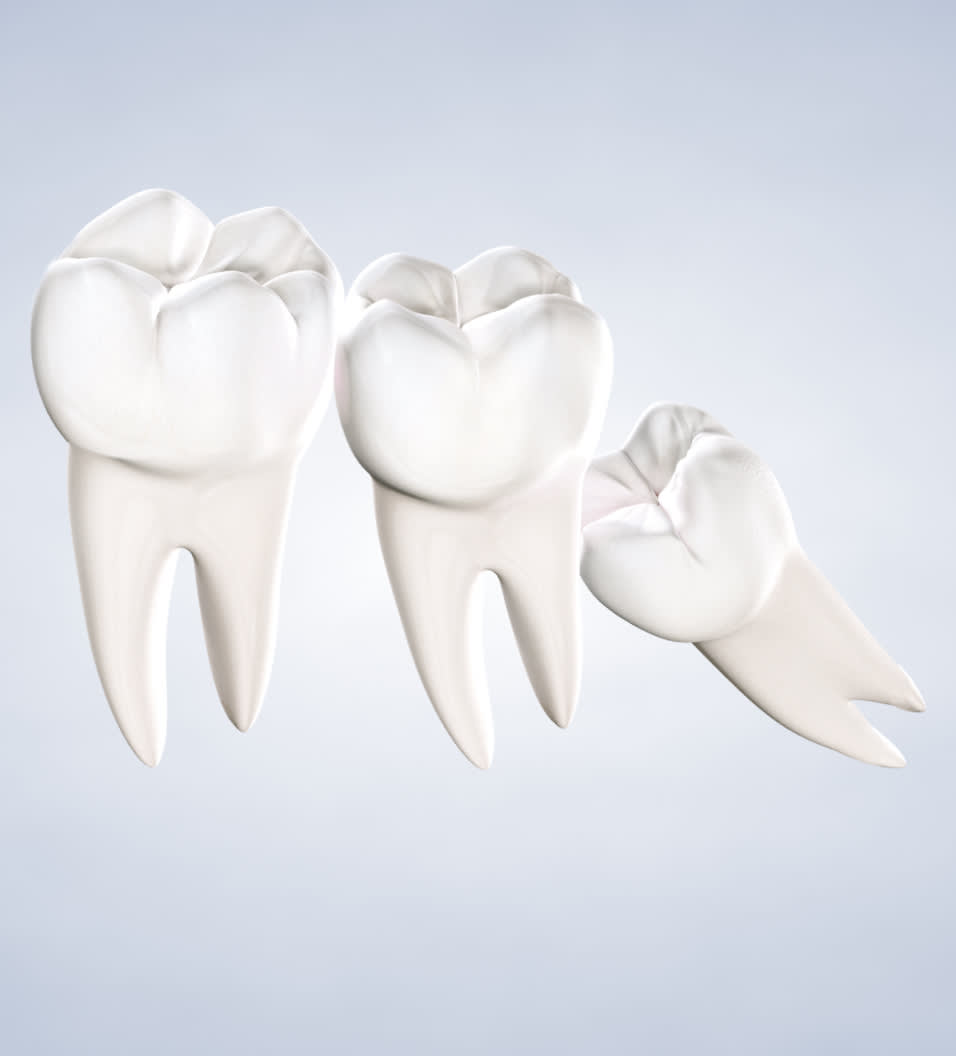 query  wisdom teeth removal